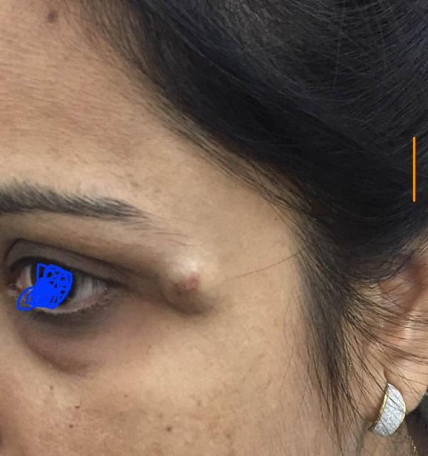 Epidermal cyst are very common