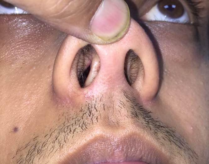 Septoplasty is important part