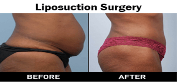 Liposuction Surgery