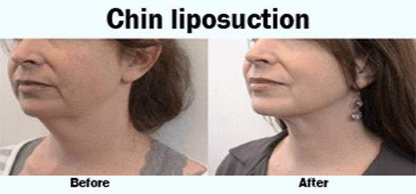 Liposuction Surgery