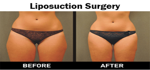 Back Rolls / Bra Strap Fat Removal, Liposuction in Delhi