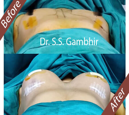 Breast Augmentation in Delhi Surgery Breast Implant in Delhi