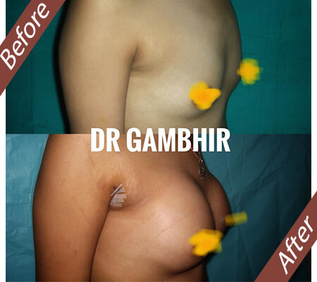 Breast Augmentation Surgery:The Best Solution for Small Breasts, Breast  Enlargement Surgery in Delhi 