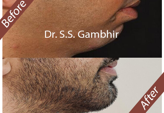 chin reshaping