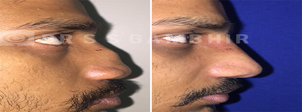 nose surgery price in india