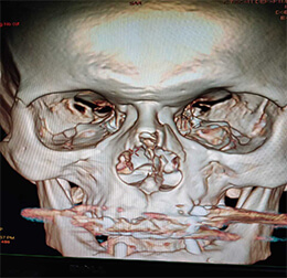 facial fracture