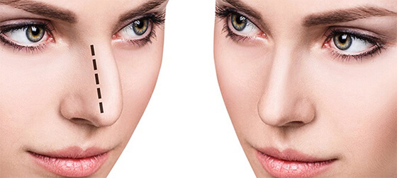 rhinoplasty cost in delhi