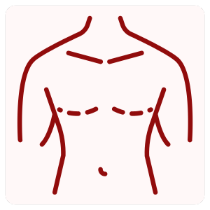 Male Breast Reduction Surgery