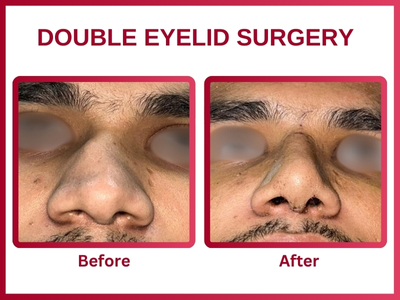 Double eyelid surgery 2