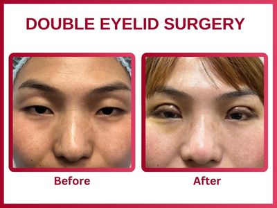 Double eyelid surgery