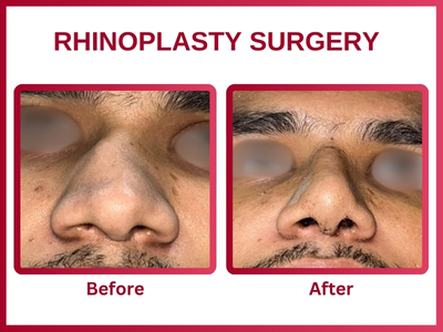 Rhinoplasty surgery Before & After 1