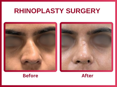 Rhinoplasty surgery Before & After 2