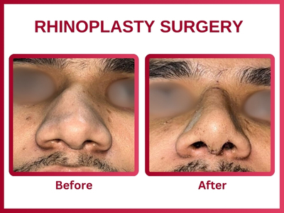 Rhinoplasty surgery Before & After 3