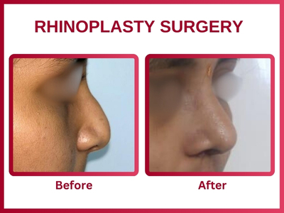 Rhinoplasty surgery Before & After 4