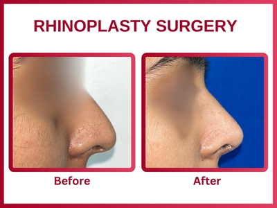 Rhinoplasty surgery Before & After 5