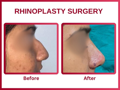 Rhinoplasty surgery Before & After 6