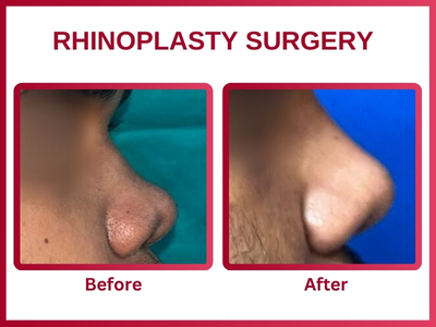 Rhinoplasty surgery Before & After 7