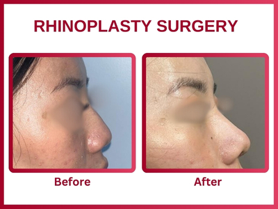 Rhinoplasty surgery Before & After 8