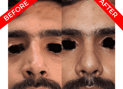 rhinoplasty surgery