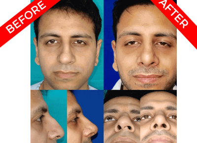 rhinoplasty surgery