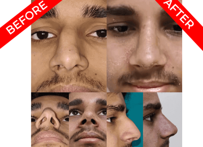 rhinoplasty surgery