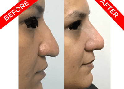 rhinoplasty surgery