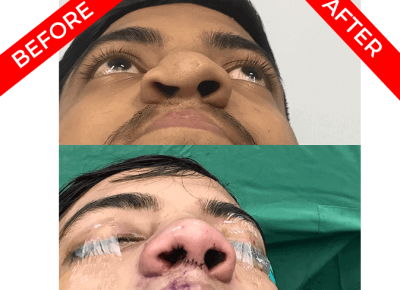 rhinoplasty surgery