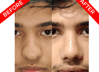 rhinoplasty surgery