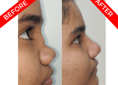 rhinoplasty surgery