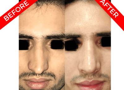 rhinoplasty surgery