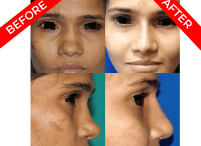 rhinoplasty surgery