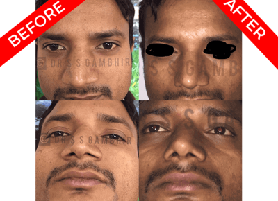 rhinoplasty surgery