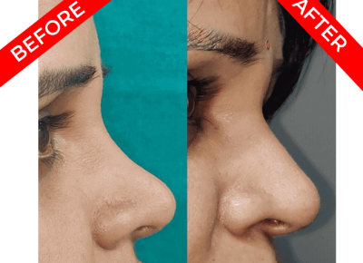 rhinoplasty surgery