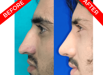 rhinoplasty surgery