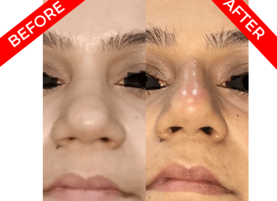 rhinoplasty surgery