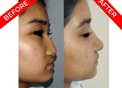 rhinoplasty surgery