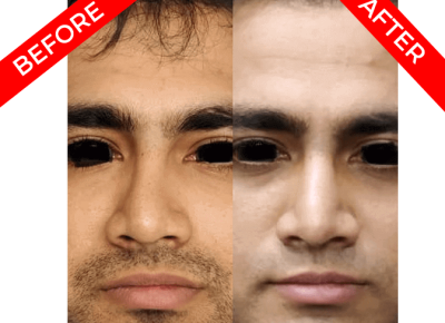 rhinoplasty surgery