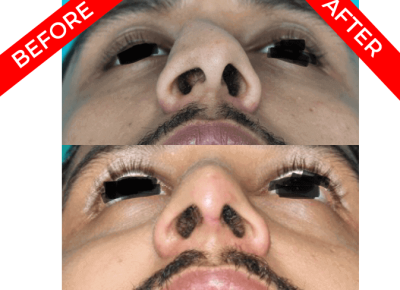 rhinoplasty surgery