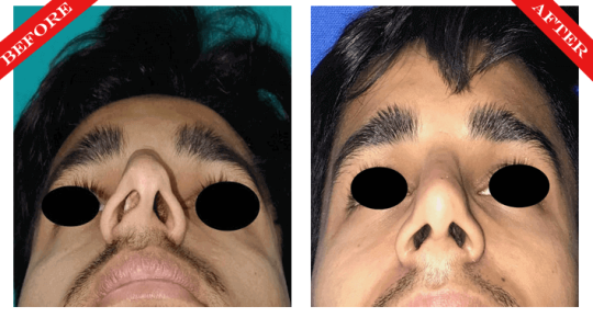 rhinoplasty surgery