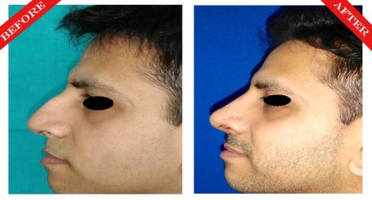 rhinoplasty surgery