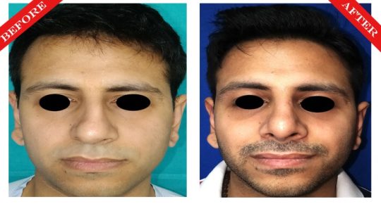 rhinoplasty surgery