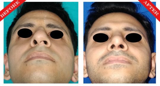 rhinoplasty surgery