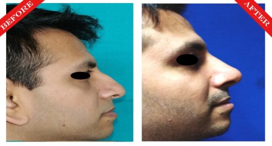 rhinoplasty surgery