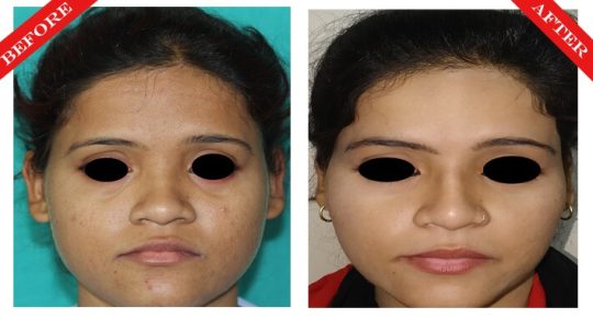 rhinoplasty surgery