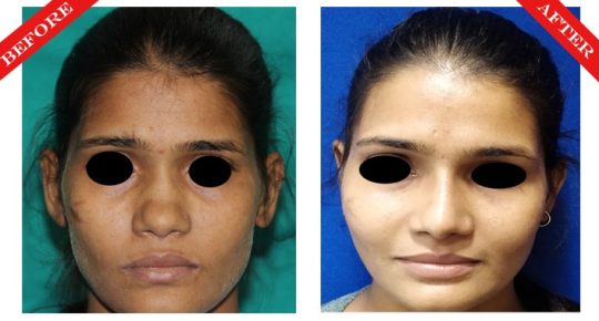 rhinoplasty surgery