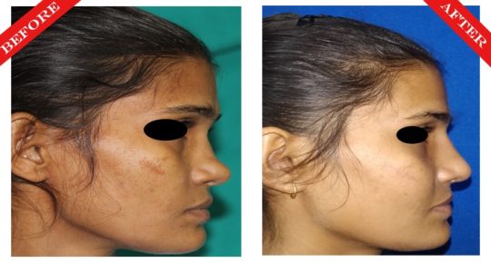 rhinoplasty surgery