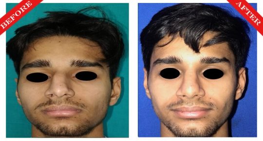 rhinoplasty surgery