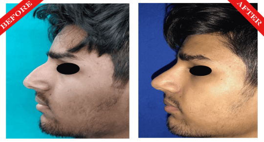 rhinoplasty surgery