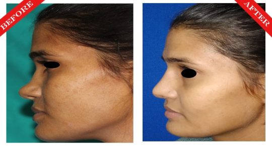 rhinoplasty surgery