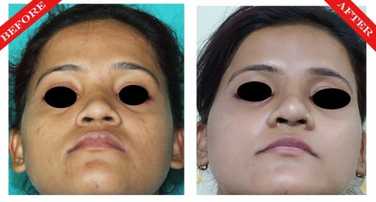 rhinoplasty surgery